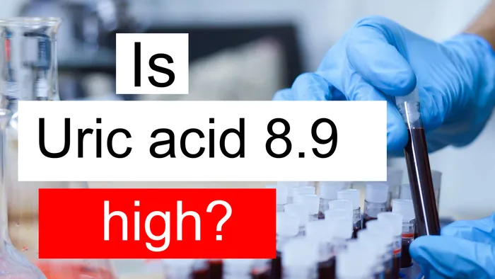 Uric acid 8.9